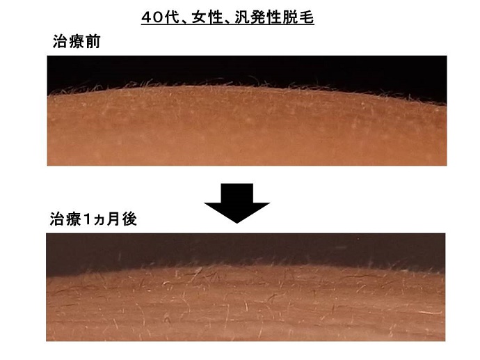 円形脱毛症　病院""